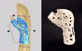 IBV développe une méthodologie semi-automatique des implants personnalisés et une méthodologie d'orthose